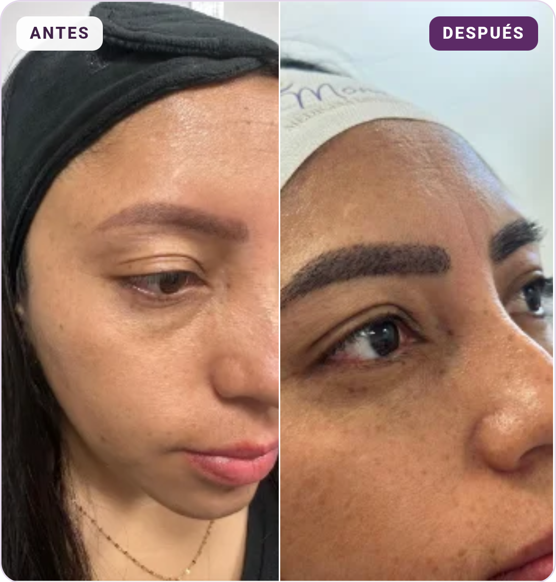 Antes y después de implante capilar en cejas