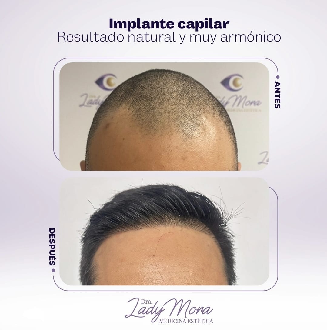 Antes y después de implante capilar en cuero cabelludo, línea frontal