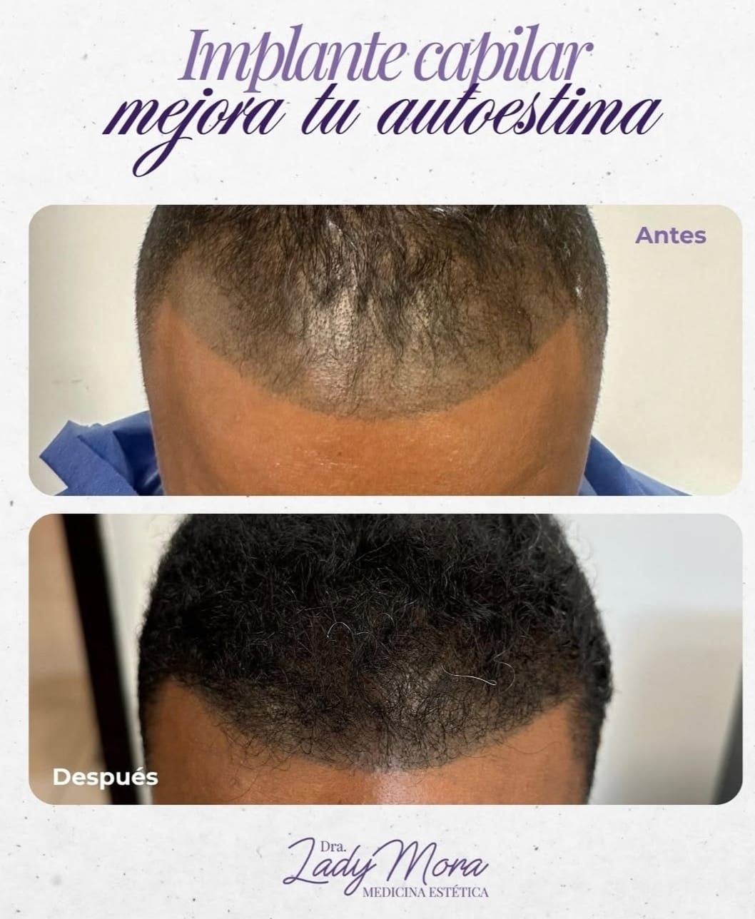 Antes y después de implante capilar, densidad frontal