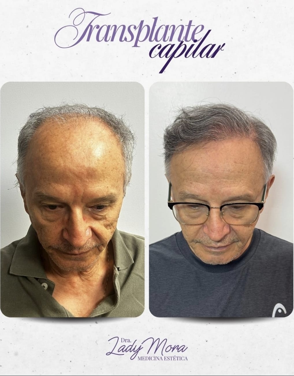 Resultado real de implante capilar: antes y después en zona cabeza